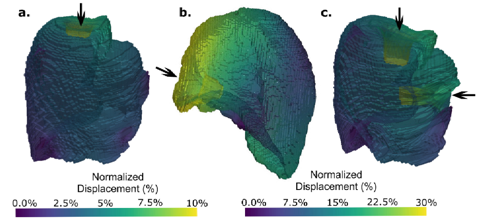 Fig. 4. (a) Tumour mesh under single-point compression at the top, producing a localised indentation with a maximum normalised displacement of 10% of the tumour’s total height. (b) Increased deformation magnitude and shifted compression location, showing asymmetric displacement distribution. (c) Multiple-point compression applied at the top and side of the tumour mesh, simulating complex loading conditions with maximum normalised displacement reaching 30%. The displacement is visualized using a colour gradient, where higher displacement values are represented in yellow and lower displacement values in purple. (Color figure online)